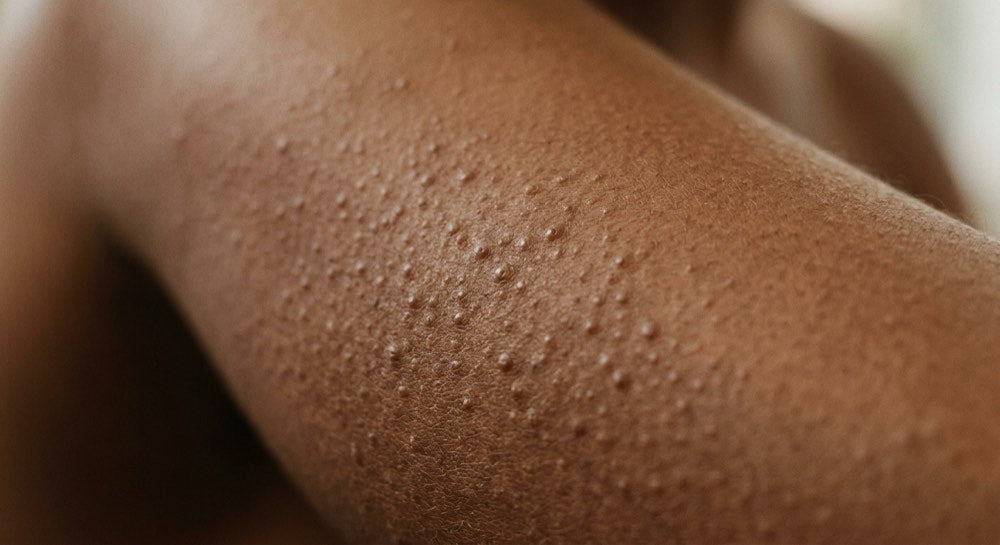 Granitos queratosis